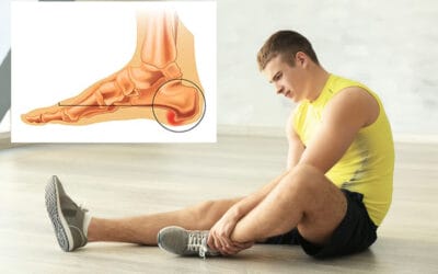 Nyeri telapak kaki saat menapak? Hati-hati ada Bone Spur di Kaki