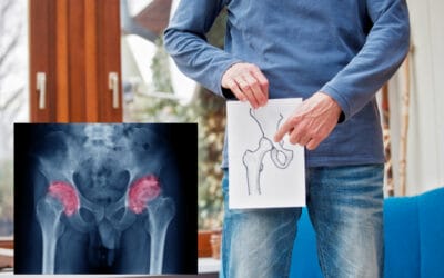 Pengapuran Sendi Panggul (Osteoarthritis Hip)