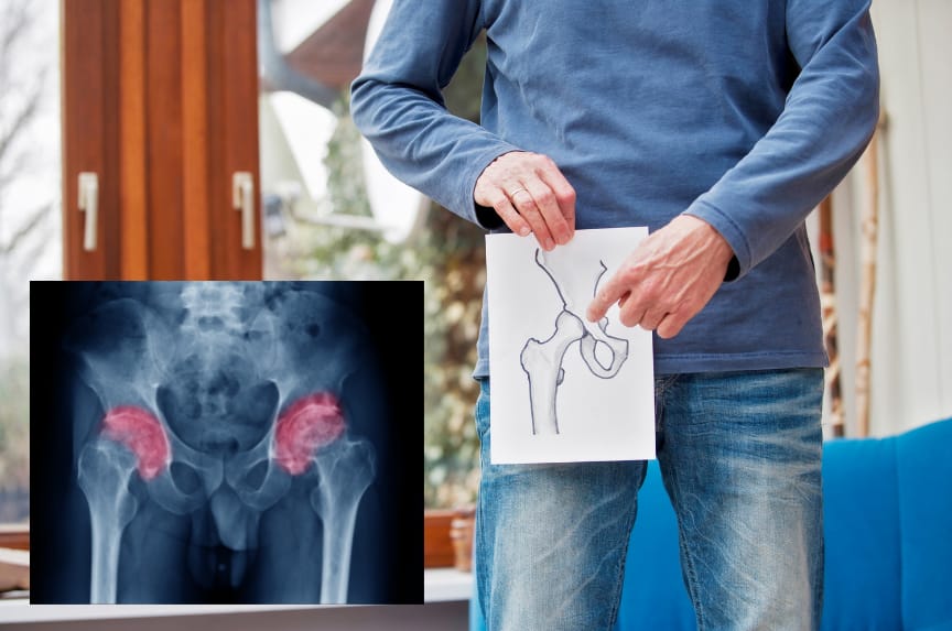 Pengapuran Sendi Panggul (Osteoarthritis Hip)