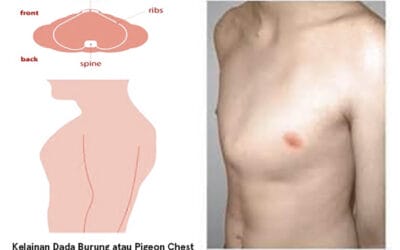 Mengenal Kelainan Dada Burung atau Pigeon Chest