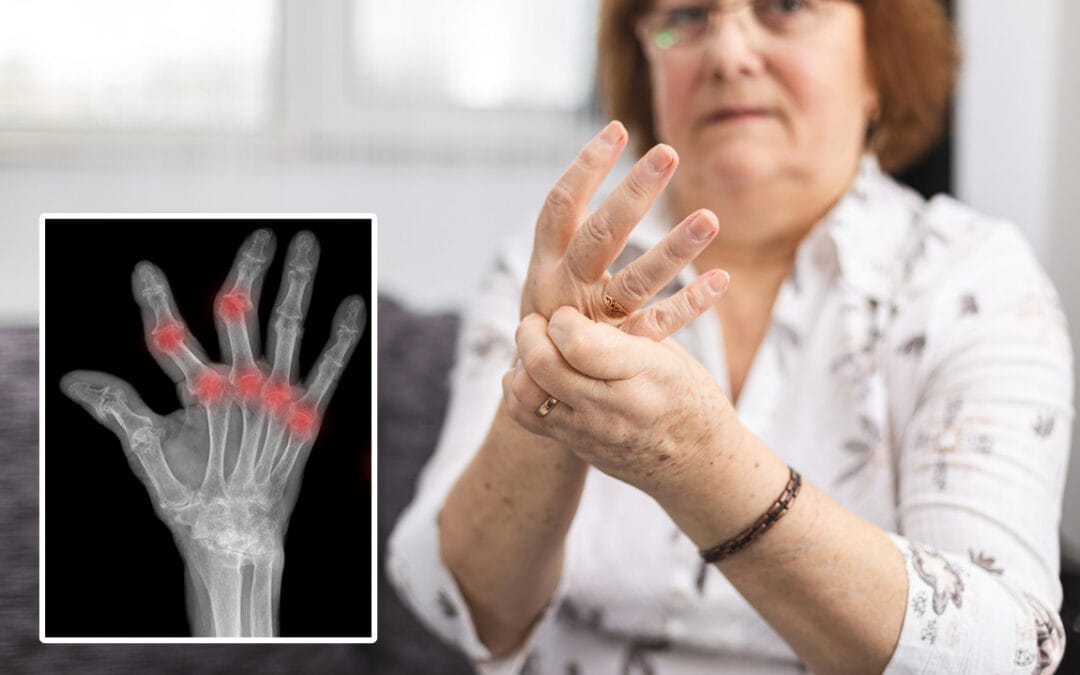 Mengenal Penyakit Rheumatoid Arthritis