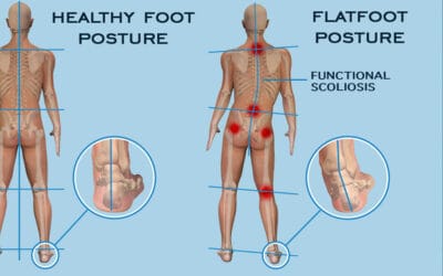 Perburukan Skoliosis Dapat Disebabkan Ketidakseimbangan Pada Kaki!