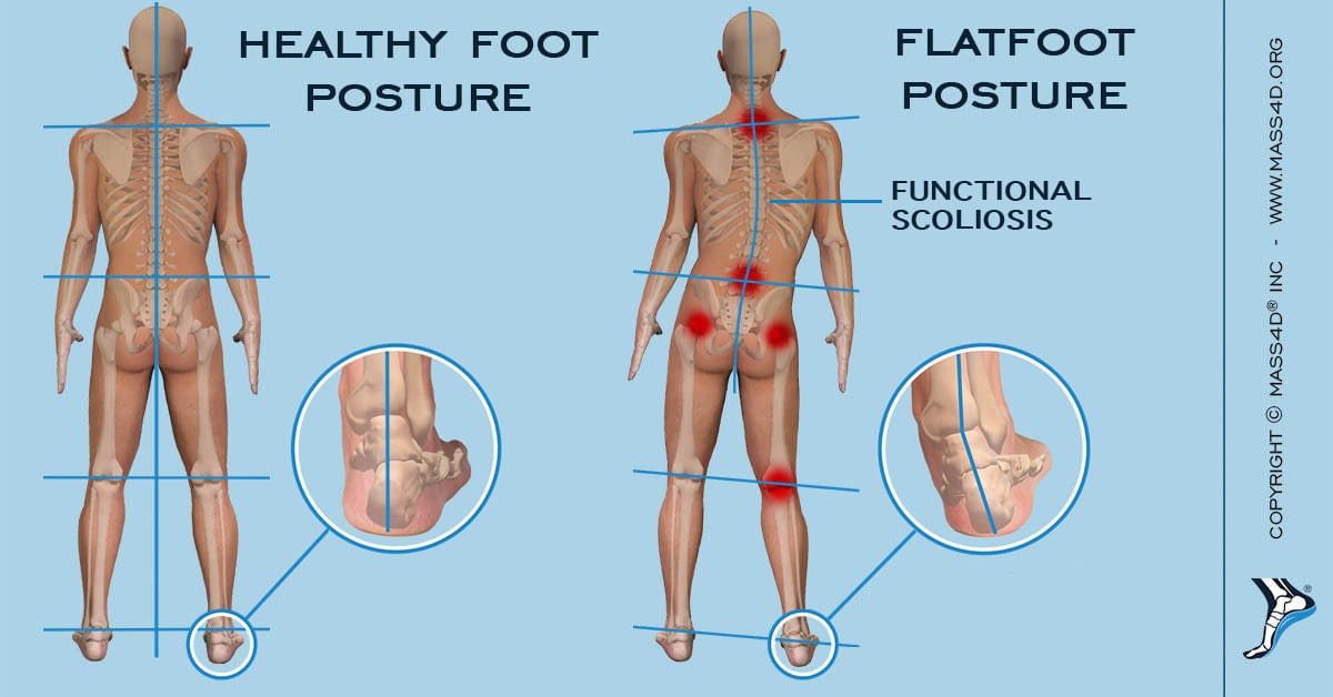 Flat-Foot-Postur-New