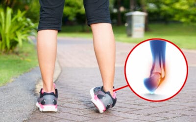 Ankle Sprain – Keseleo pada pergelangan kaki