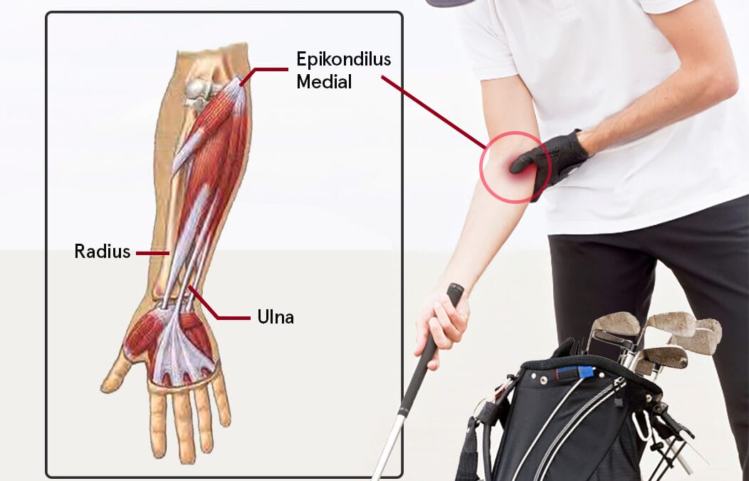 Golfer Elbow – Nyeri pada Siku Bagian Dalam Dan 4 Penyebabnya!