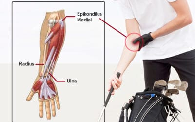 Golfer Elbow – Nyeri pada Siku Bagian Dalam Dan 4 Penyebabnya!