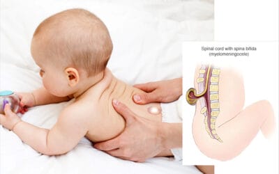 Spine Bifida: Penyebab Utama dan 2 Pengobatannya