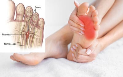 MORTON’S NEUROMA