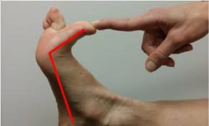 Morton’s Neuroma, nyeri telapak kaki, kaki datar
