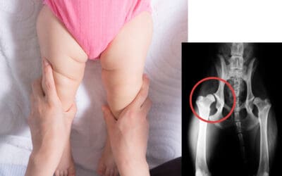 Mengenal Kelainan Bentuk Pinggul: Hip Dysplasia