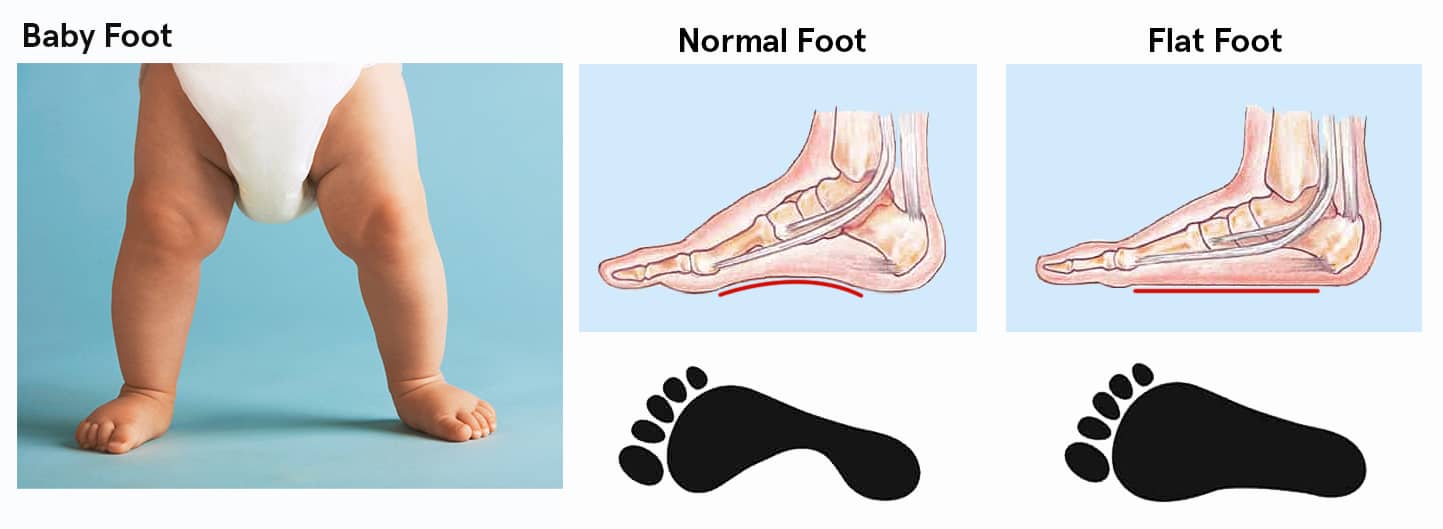 kaki normal, flat feet, kaki datar