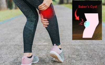 Mengenal Penyakit Kista Baker (Baker’s Cyst)