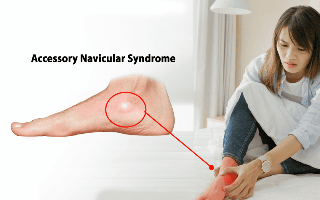 Mengenal Accessory Navicular Syndrome