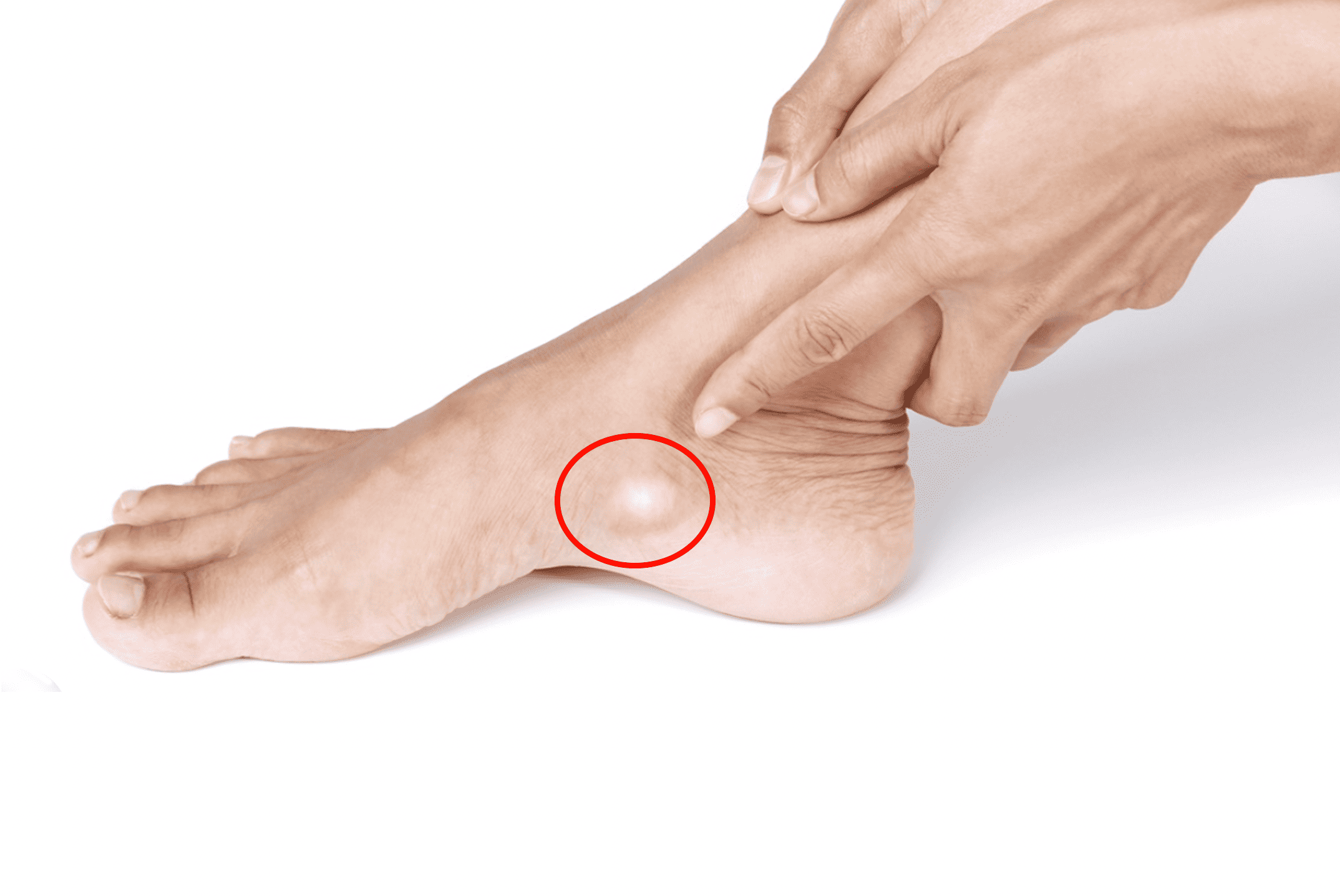 Mengenal Accessory Navicular Syndrome Klinik Tulang Belakang