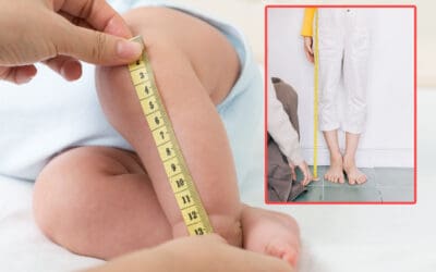 Apa Itu Kelainan Kaki Panjang Sebelah, Penyebab dan Pengobatannya