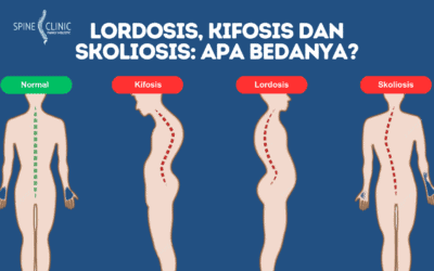 Kesulitan Membedakan Lordosis, Kifosis, dan Skoliosis? Cek Penjelasannya!
