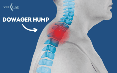 Apa itu Dowager Hump dan Bagaimana Cara Menanganinya?