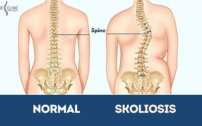 Kenali Skoliosis: Penyebab, Gejala dan Pengobatan yang Efektif